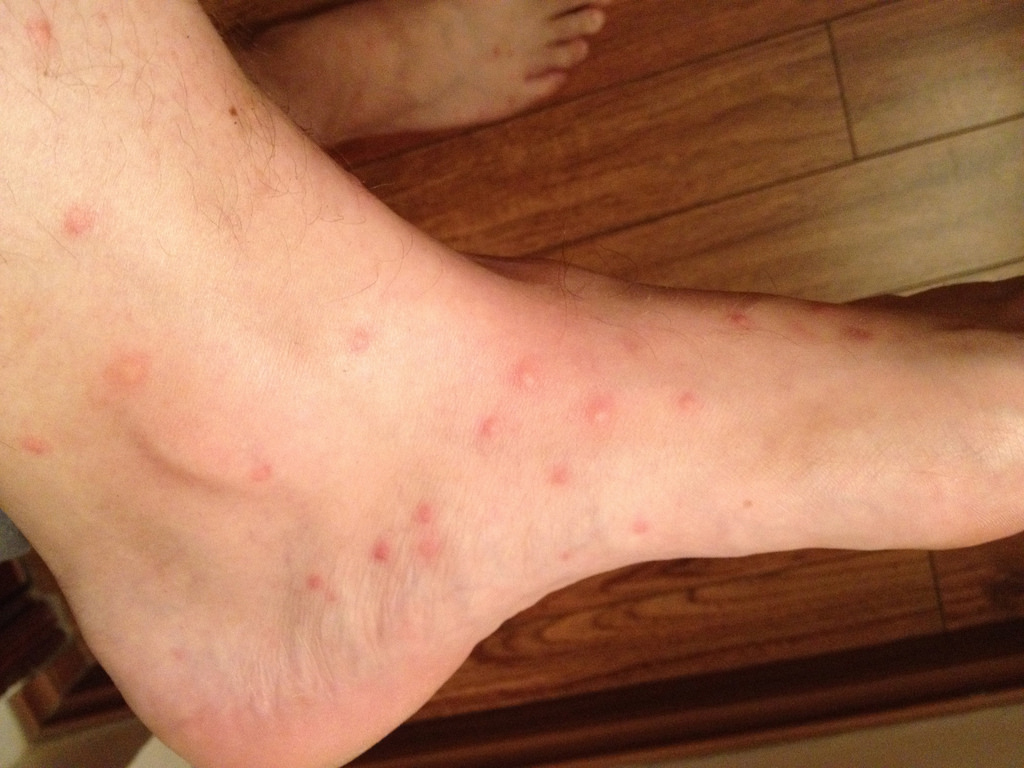 Flea bites on foot