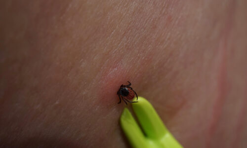 Tick Removal