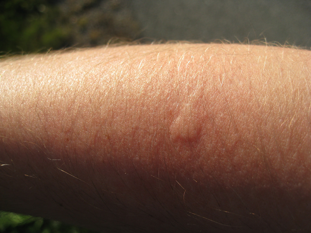Mosquito sting on arm